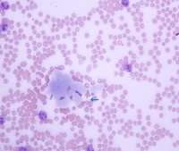 Figure 4. Peripheral smear 40X, Leishman Stain showing pale blue deposits of cryoglobulins in the body of the smear