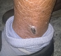 Figure 7. Skin Lesions in a case of Lymphoplasmacytic Lymphoma Skin lesion at the ankle in a case of Lymphoplasmacytic Lymphoma