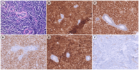 Unusual Presentation: Relapse of B-Cell Acute Lymphoblastic Leukemia as a Breast Mass