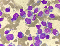 Bone marrow aspirate revealed 92% clonal plasma cells with atypical morphology (Fig A).