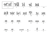 Karyotyping showed a complex hyperdiploid karyotype and 1q gain with 1p deletion (Fig B).