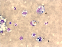 Hematin Crystals in Cerebrospinal Fluid