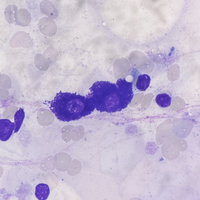 Mast cell in Bone Marrow Aspiration