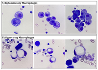 Macrophage in BALF