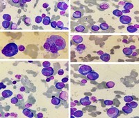 Plasma cell dyscrasia 1