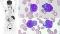 EBV-related LPD. Figure 1. PET/CT and PB film