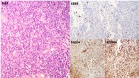 EBV-related LPD. Figure 2. Bone marrow histology (H&E, EBER, kappa and lambda stain)