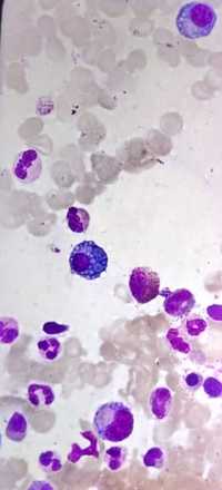 MOTT CELLS IN BONE MARROW ASPIRATE SMEARS