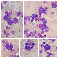 Plasma cell myeloma