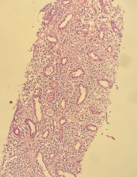 Renal biopsy involved by follicular lymphoma, low-power