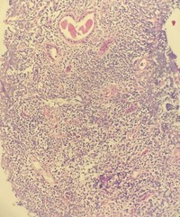 Renal biopsy involved by follicular lymphoma, intermediate-power