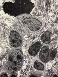 Follicular lymphoma by electron microscopy #1