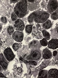 Follicular lymphoma by electron microscopy #2