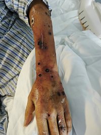 Invasive Fusarium infection