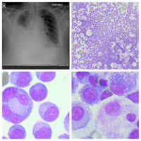 Flow Cytometry an Important Diagnostic Tool in Myelomatous Pleural Effusion 1