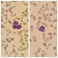 Blasts in Acute Promyelocytic Leukemia