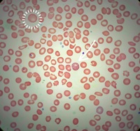 ANEMIA