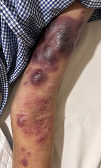 Mycosis fungoides