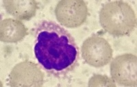 Sezary Cell 1