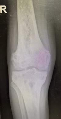 Lytic bone lesions with sclerosed margins 1