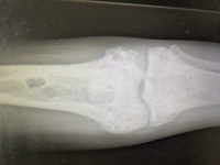 Lytic bone lesions with sclerosed margins 2