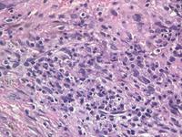 Langerhans Cells in Bone marrow biopsy 2