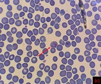 Plasmodium vivax ring form with s single chromatin dot