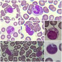 Image 1: Chediak-Higashi peripheral blood leukocytes.