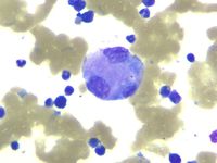 Secondary Hemophagocytic Lymphohistiocytosis in a Case of Pulmonary Adenocarcinoma with Multiple Metastases and Concurrent Infection 1