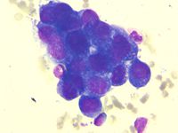 Secondary Hemophagocytic Lymphohistiocytosis in a Case of Pulmonary Adenocarcinoma with Multiple Metastases and Concurrent Infection 2