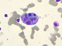 Secondary Hemophagocytic Lymphohistiocytosis in a Case of Pulmonary Adenocarcinoma with Multiple Metastases and Concurrent Infection 3