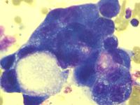 Secondary Hemophagocytic Lymphohistiocytosis in a Case of Pulmonary Adenocarcinoma with Multiple Metastases and Concurrent Infection 4