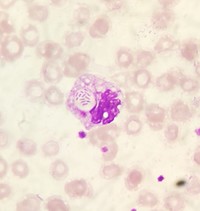 DETECTION OF BACTEREMIA ON PERIPHERAL BLOOD SMEAR.