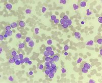 Acute Basophilic Leukaemia