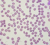Thrombotic Thrombocytopenic Purpura