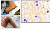 An Anticonvulsant (Levipil) induced Drug Reaction with Eosinophilia and Systemic Symptoms (DRESS)