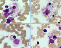 Secondary Hemophagocytic Lymphohistiocytosis