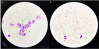 EDTA-induced pseudothrombocytopenia with Citrate correction