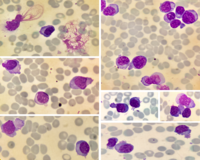 Plasma cell dyscrasia