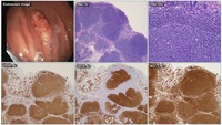 Low-grade Follicular Lymphoma Presenting as a Gastric Polyp