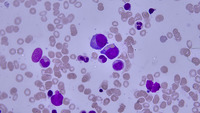 Richter transformation, DLBCL cell with erythrophagocytosis