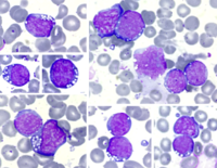 Burkitt Lymphoma