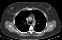 Idiopathic Multicentric Castleman Disease CT Image