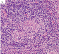 Unicentric Castleman Disease- Twinning