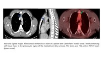 Unicentric Castleman Disease- CT Images