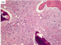 TAFRO- Bone marrow fibrosis 1