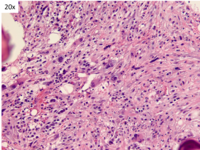 TAFRO- Bone marrow fibrosis 2