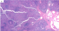 HHV8 Positive MCD- Regressed Germinal centers