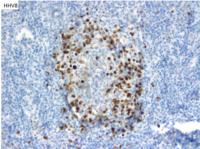 HHV8 Positive MCD- HHV8