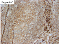 HHV8 Positive MCD- Kappa IHC